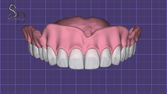 Full Denture