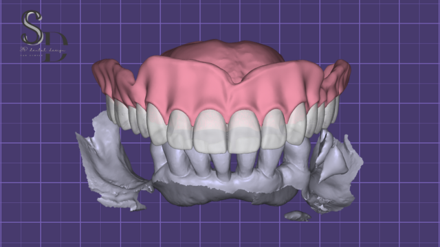 Full Denture