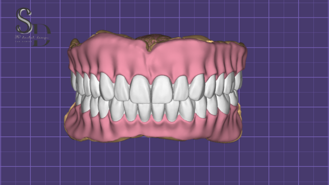 Full Denture