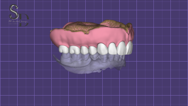 Full Denture